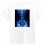 Foto Photo t-shirt of Cálculos renales, radiografía abdominal foto 237461